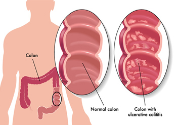 Colitis