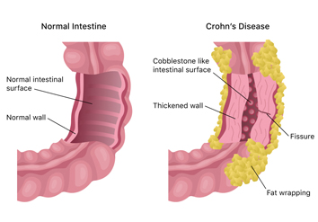 Crohn's disease