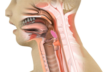 Difficulty in swallowing