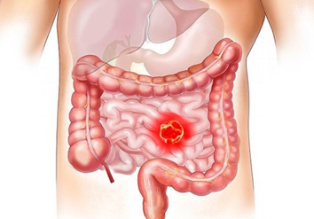 Colonoscopy