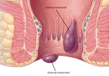 Hemorrhoids