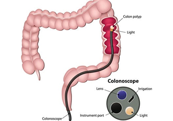 Screening/Surveillance